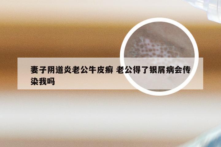 妻子阴道炎老公牛皮癣 老公得了银屑病会传染我吗