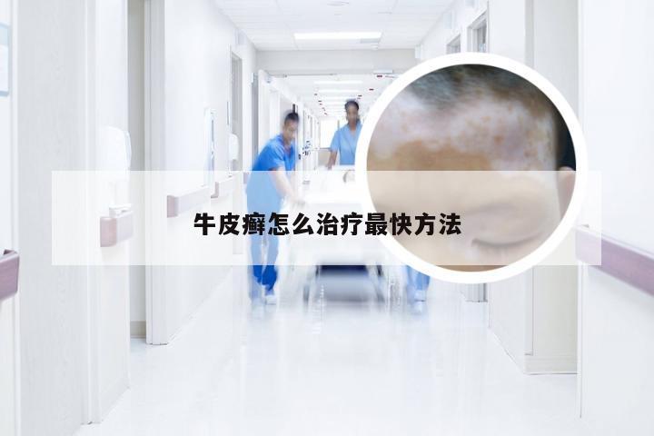 牛皮癣怎么治疗最快方法