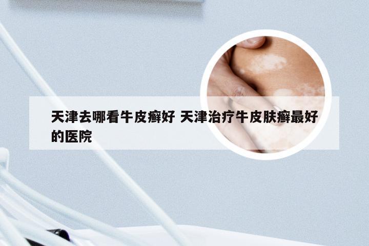 天津去哪看牛皮癣好 天津治疗牛皮肤癣最好的医院