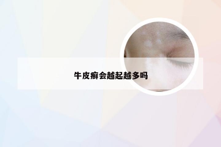 牛皮癣会越起越多吗
