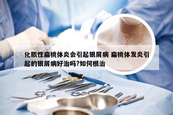 化脓性扁桃体炎会引起银屑病 扁桃体发炎引起的银屑病好治吗?如何根治