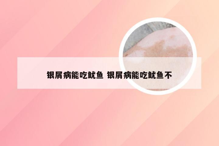 银屑病能吃鱿鱼 银屑病能吃鱿鱼不