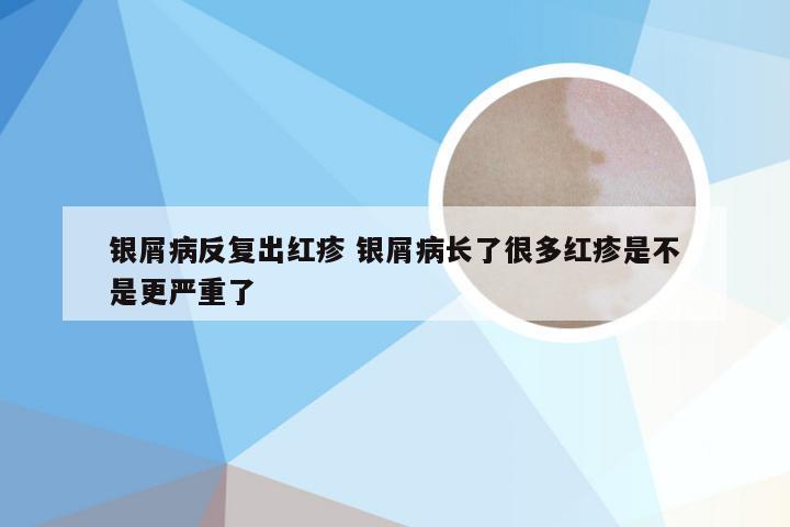 银屑病反复出红疹 银屑病长了很多红疹是不是更严重了
