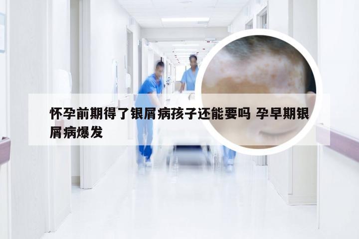 怀孕前期得了银屑病孩子还能要吗 孕早期银屑病爆发
