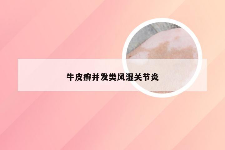 牛皮癣并发类风湿关节炎