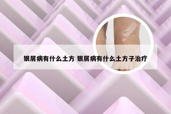 银屑病有什么土方 银屑病有什么土方子治疗