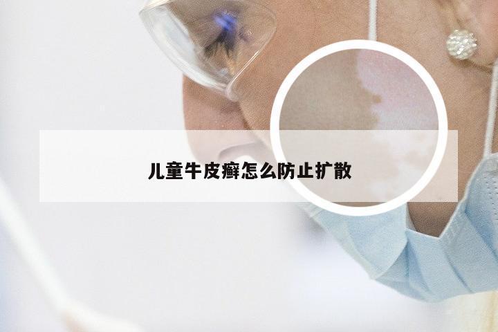 儿童牛皮癣怎么防止扩散