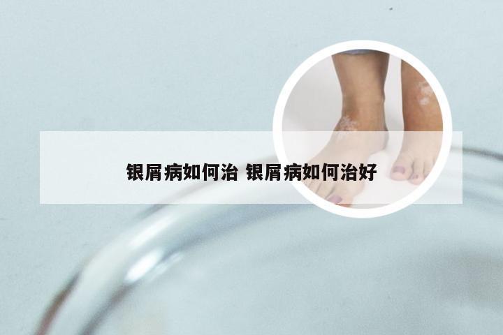 银屑病如何治 银屑病如何治好