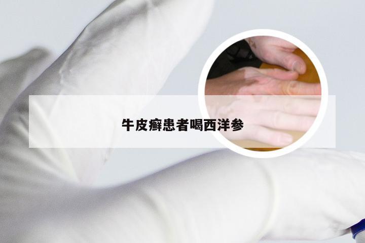 牛皮癣患者喝西洋参