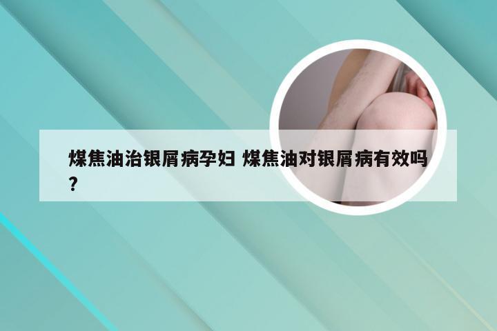 煤焦油治银屑病孕妇 煤焦油对银屑病有效吗?