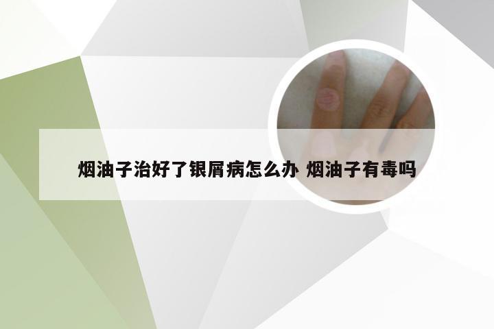 烟油子治好了银屑病怎么办 烟油子有毒吗