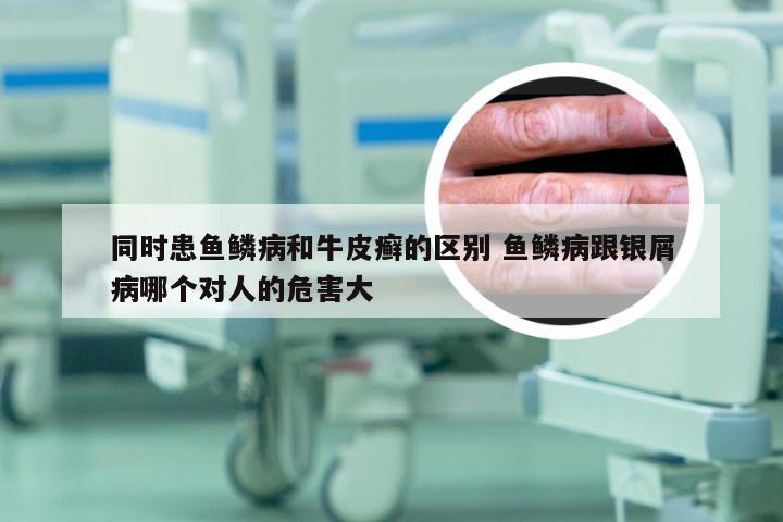 同时患鱼鳞病和牛皮癣的区别 鱼鳞病跟银屑病哪个对人的危害大