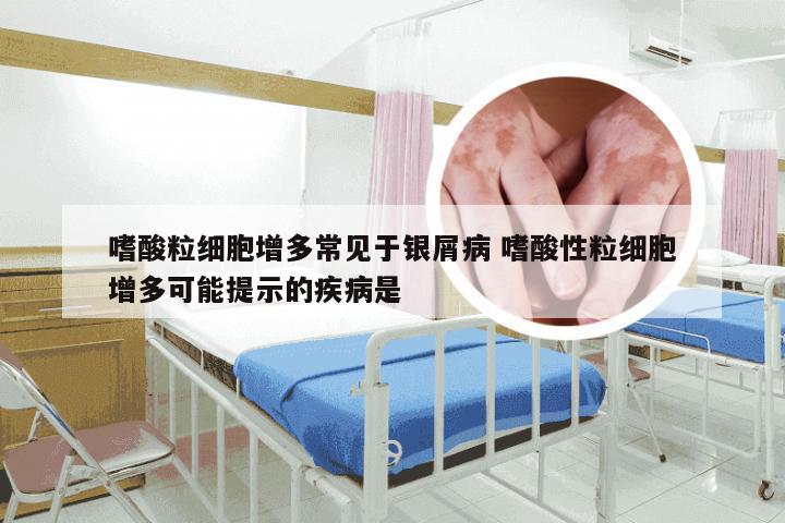 嗜酸粒细胞增多常见于银屑病 嗜酸性粒细胞增多可能提示的疾病是