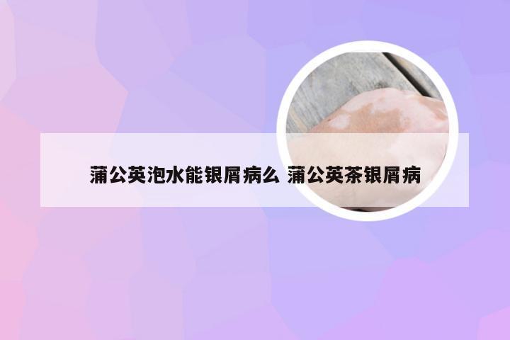 蒲公英泡水能银屑病么 蒲公英茶银屑病