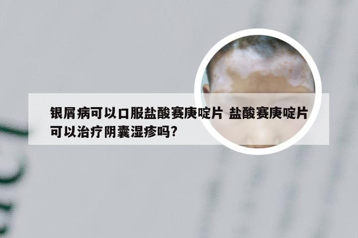 银屑病可以口服盐酸赛庚啶片 盐酸赛庚啶片可以治疗阴囊湿疹吗?