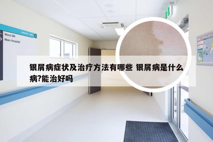 银屑病症状及治疗方法有哪些 银屑病是什么病?能治好吗
