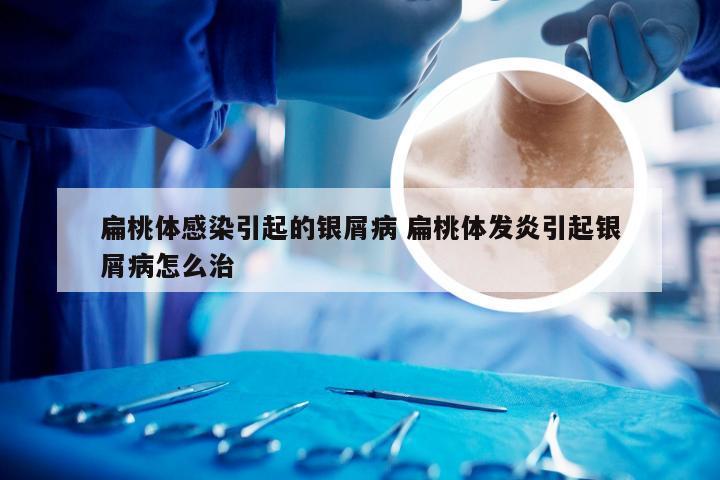 扁桃体感染引起的银屑病 扁桃体发炎引起银屑病怎么治