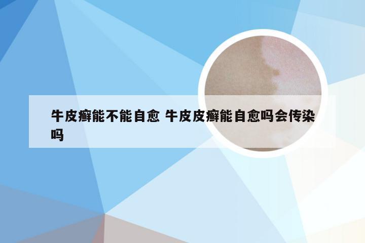 牛皮癣能不能自愈 牛皮皮癣能自愈吗会传染吗