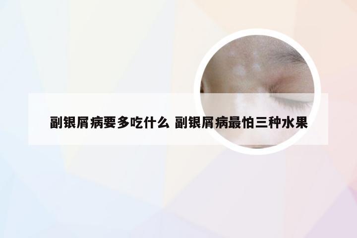 副银屑病要多吃什么 副银屑病最怕三种水果