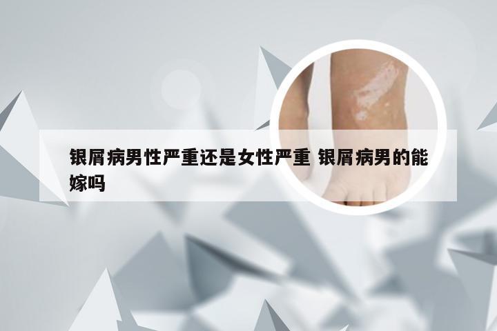 银屑病男性严重还是女性严重 银屑病男的能嫁吗
