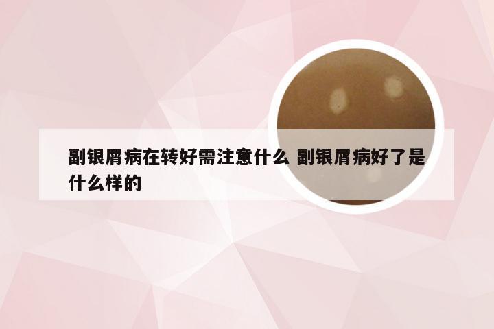 副银屑病在转好需注意什么 副银屑病好了是什么样的