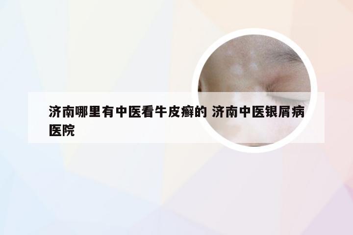 济南哪里有中医看牛皮癣的 济南中医银屑病医院