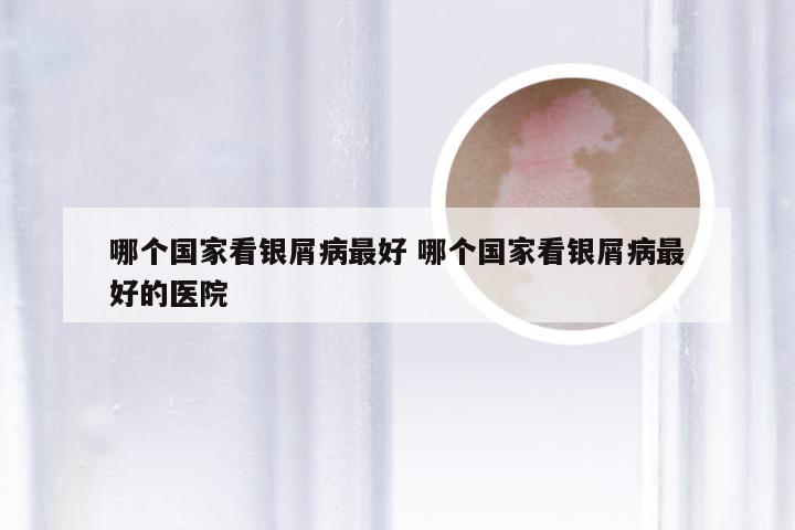 哪个国家看银屑病最好 哪个国家看银屑病最好的医院