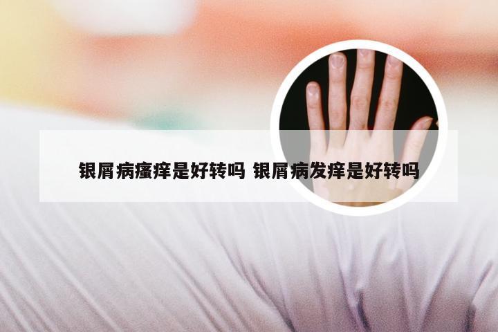 银屑病瘙痒是好转吗 银屑病发痒是好转吗