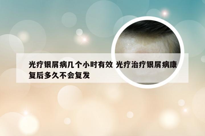 光疗银屑病几个小时有效 光疗治疗银屑病康复后多久不会复发