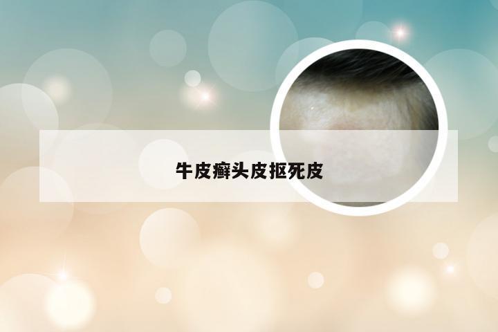 牛皮癣头皮抠死皮