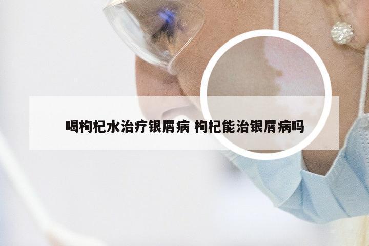 喝枸杞水治疗银屑病 枸杞能治银屑病吗