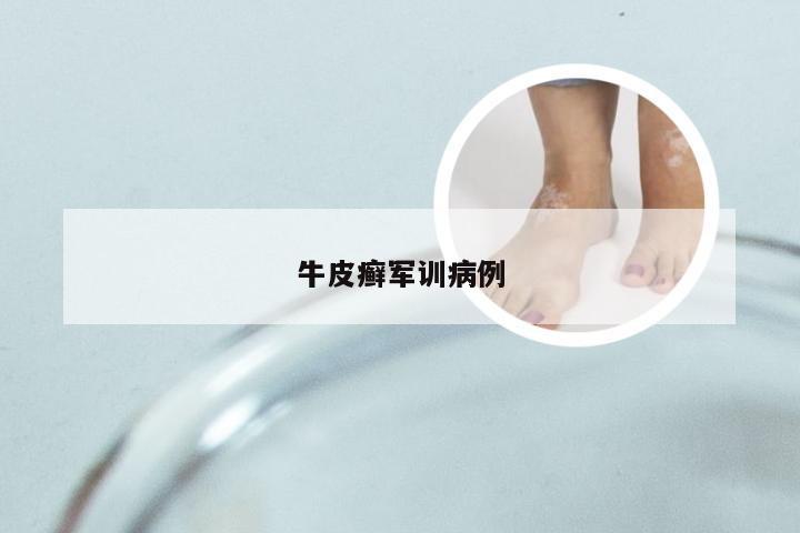 牛皮癣军训病例