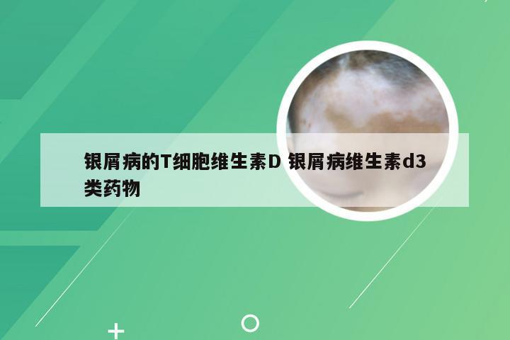 银屑病的T细胞维生素D 银屑病维生素d3类药物