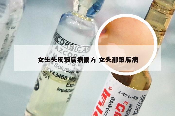 女生头皮银屑病偏方 女头部银屑病