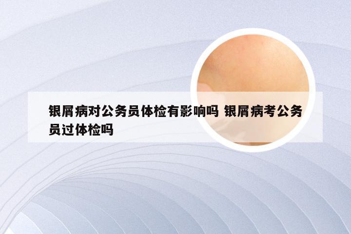 银屑病对公务员体检有影响吗 银屑病考公务员过体检吗