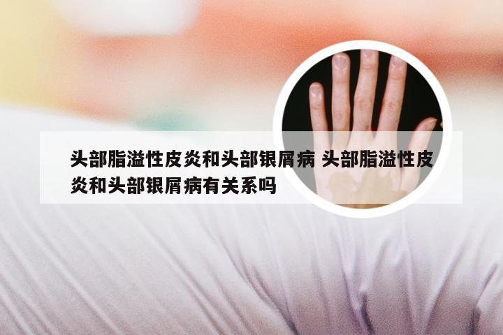 头部脂溢性皮炎和头部银屑病 头部脂溢性皮炎和头部银屑病有关系吗
