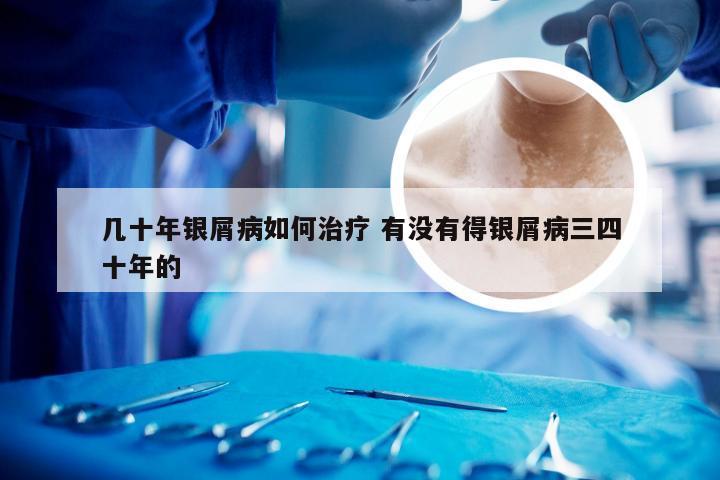 几十年银屑病如何治疗 有没有得银屑病三四十年的