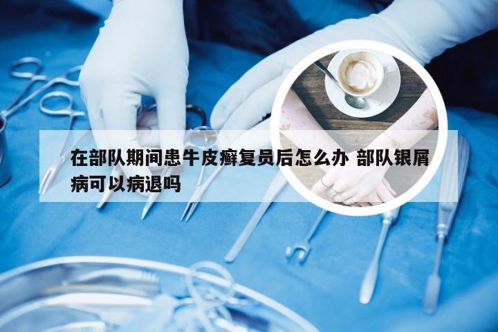 在部队期间患牛皮癣复员后怎么办 部队银屑病可以病退吗