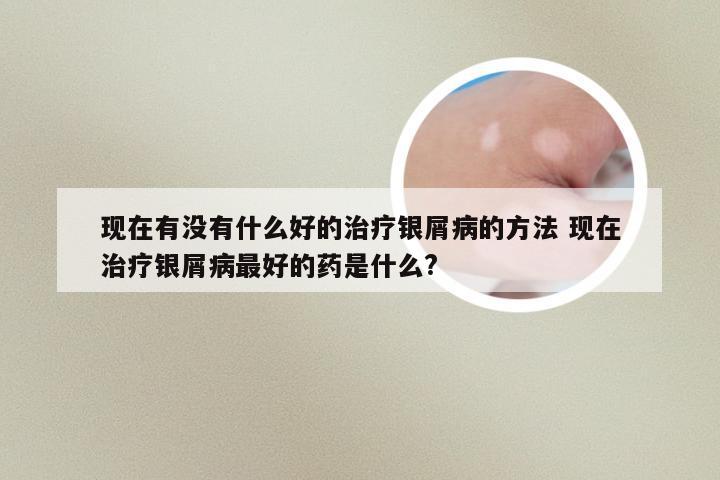 现在有没有什么好的治疗银屑病的方法 现在治疗银屑病最好的药是什么?