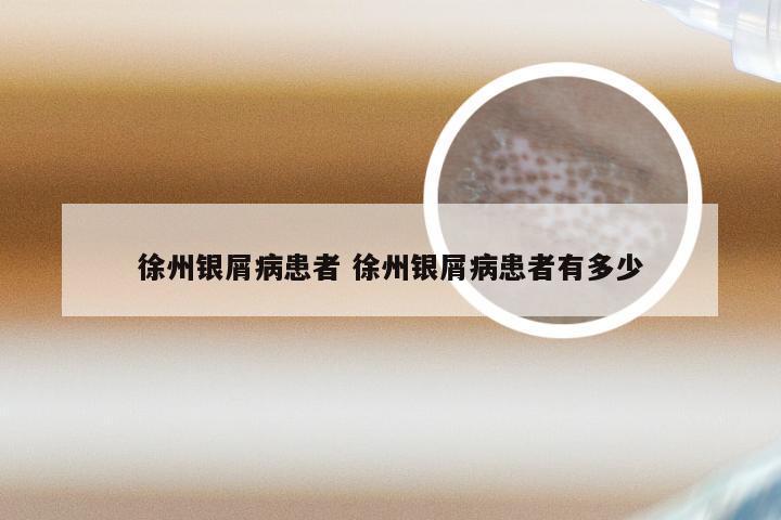 徐州银屑病患者 徐州银屑病患者有多少