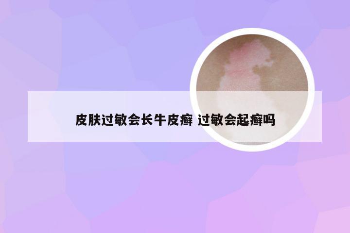 皮肤过敏会长牛皮癣 过敏会起癣吗