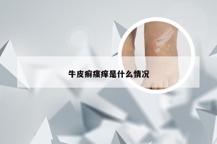 牛皮癣瘙痒是什么情况