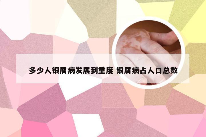 多少人银屑病发展到重度 银屑病占人口总数