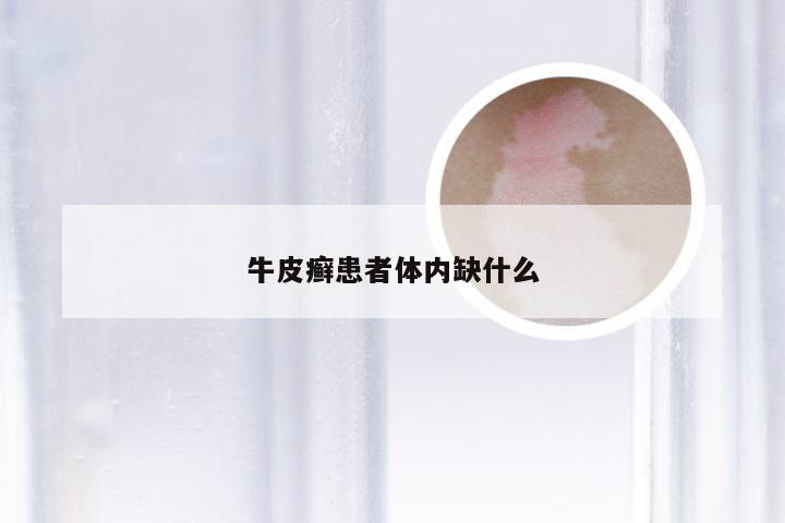 牛皮癣患者体内缺什么