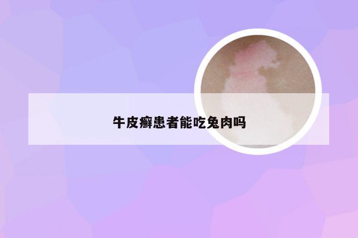 牛皮癣患者能吃兔肉吗