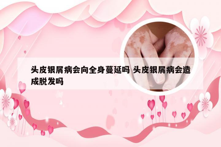 头皮银屑病会向全身蔓延吗 头皮银屑病会造成脱发吗