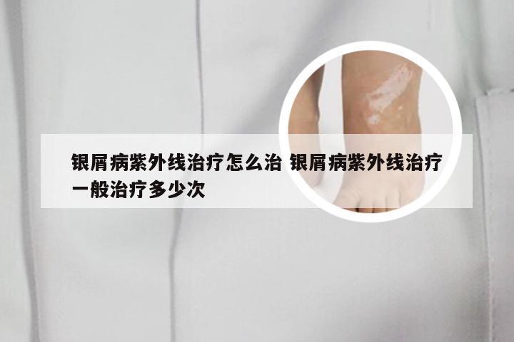 银屑病紫外线治疗怎么治 银屑病紫外线治疗一般治疗多少次