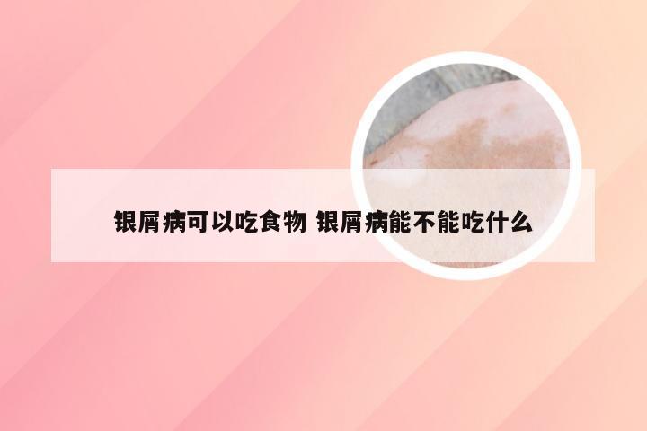 银屑病可以吃食物 银屑病能不能吃什么