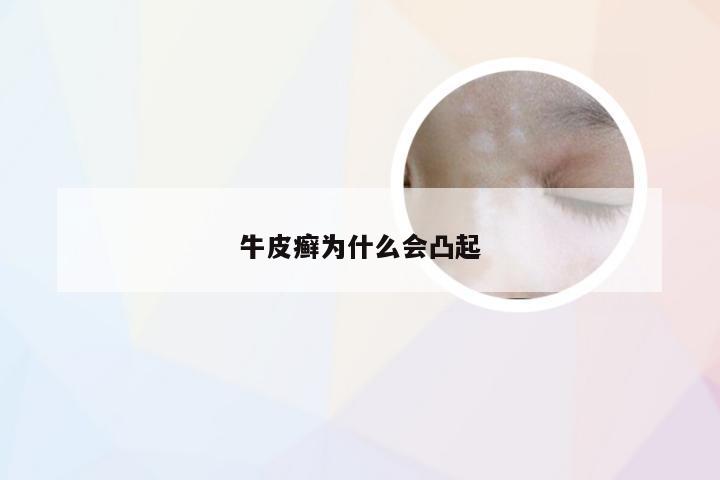 牛皮癣为什么会凸起