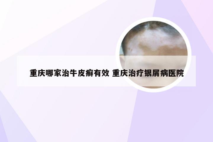 重庆哪家治牛皮癣有效 重庆治疗银屑病医院